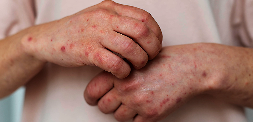 PANAMA EN DIRECTO - Pérdida del estatus de eliminación del sarampión en Las Américas: Un reto para la Salud Pública